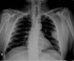 Solitary bone <b>plasmacytoma</b>
