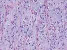<b>liposarcoma mixoide</b> típico