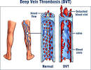 Deep Vein Thrombosis and Fibromyalgia