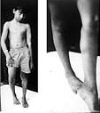 of <b>Stiff Person Syndrome</b>