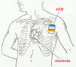 Implantable cardioverter-defibrillator - Wikipedia, the free ...