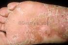 <b>Reiter Syndrome</b> Photo - Skin Disease Pictures