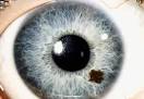Typical <b>iris</b> nevus.