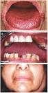 of <b>Sjögren's syndrome</b>