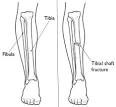 Tibia  Shinbone  Shaft Fractures   OrthoInfo   AAOS