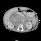 File:<b>Neuroblastoma</b> 102.jpg