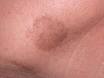 <b>Lentigo</b>
