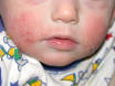 Atopic eczema, atopic dermatitis. DermNet NZ