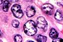 of <b>large cell lymphoma</b>,