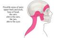 Tension Headache — UVA Health Home