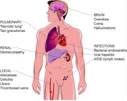Alcohol Abuse Related Problems Alcoholism is a contributor to the increasing 