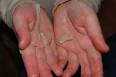 A KAWASAKI HEART - Helping to Promote Awareness of KAWASAKI DISEASE
