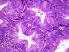 Slide: Complex <b>Endometrial Hyperplasia</b> with Atypia | Webpathology.