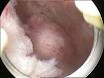 Hysteroscopy - Wikipedia, the free encyclopedia