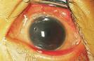 Volume 5, Chapter 59. Nutritional Blindness: <b>Xerophthalmia</b> and
