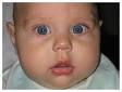 <b>Tear Duct Obstruction</b>