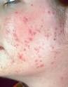  Nodular Cystic acne Treatment – Your Possibilities.