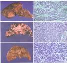 las <b>neoplasias</b> hepáticas.