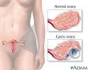 Ovarian <b>cysts</b>