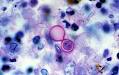 Blastomycosis - symptoms, causes, diagnosis and treatment by ...