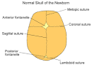 Craniosynostosis