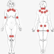 fibromialgias