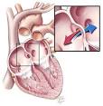 Atrial <b>Septal Defect</b> Repair