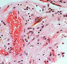 Mesothelioma Asbestos