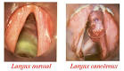 Le cancer du <b>larynx</b> est du