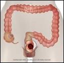 Colorectal Cancer