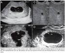 Radiologia Brasileira - First trimester pregnancy abnormalities ...