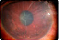 Symptoms and Signs of Keratoconus | Medindia