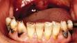 <b>Root caries</b>.