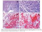 A diagnosis of <b>Langerhans cell</b>