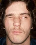 <b>Herpes Zoster Oticus</b>