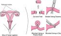 Sterilization: Family Planning: Merck Manual Home Edition