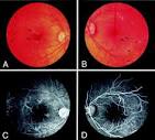 Ischemic maculopathy in patients with acquired immunodeficiency ...