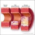 Role in Atherosclerosis: