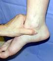 Ankle Sprains -- Dr. Chris Chiodo