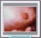 La <b>enfermedad</b> de <b>Paget</b> de la