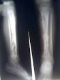 <b>Osteomyelitis</b> of the tibia of
