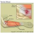<b>Tennis elbow</b> most commonly