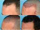 Hair Transplant Surgery