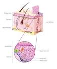 What is metastatic melanoma? - ZELBORAF (
