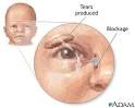 <b>Tear duct blockage</b>