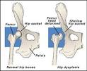 Hip dysplasia