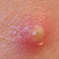 Painful Underarm Pimples (Boils) Causes, Treatments and Prevention ...