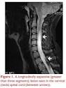Transverse <b>Myelitis</b>