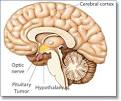 Conditions: Pituitary Adenoma (Tumor) | UCLA Neurosurgery