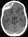 <b>intracranial hemorrhage</b>.